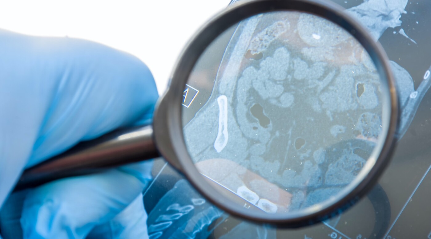 Advances in Rare Disorders